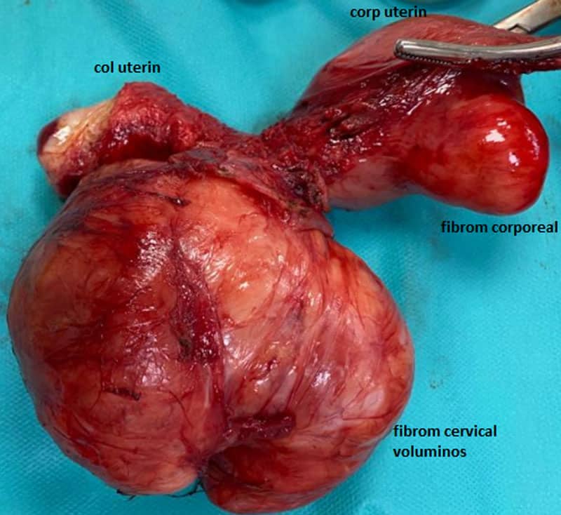 Fibrom uterin voluminos video
