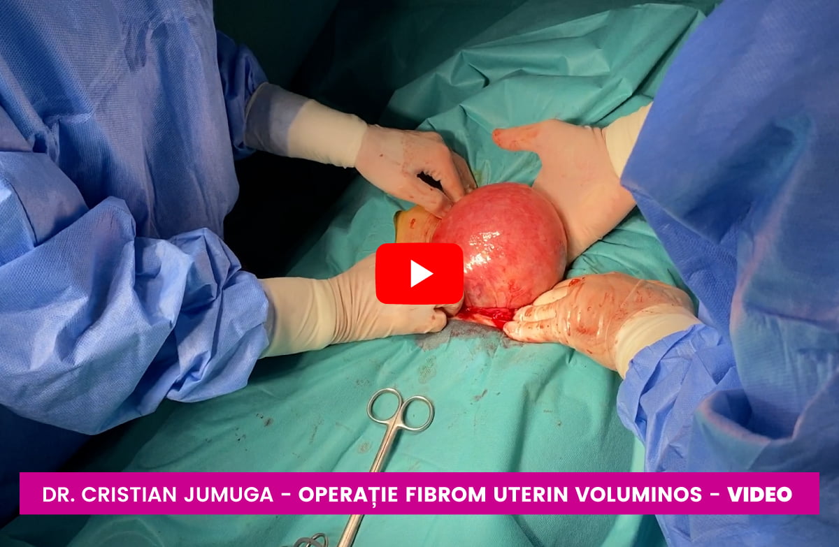 Fibrom uterin voluminos video